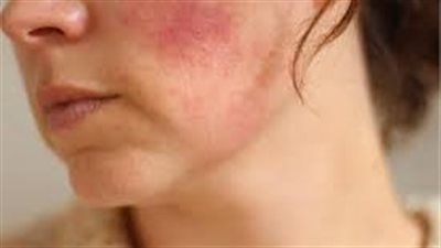 وداعاً للبقع الداكنة ما علاج تصبغات الوجه؟