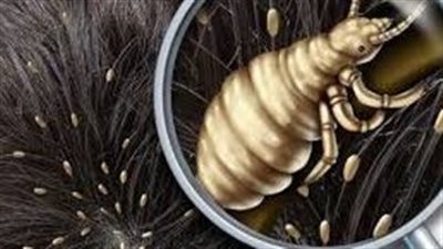 وداعاً لقمل الشعر: اكتشفي أسبابه وطرق علاجه