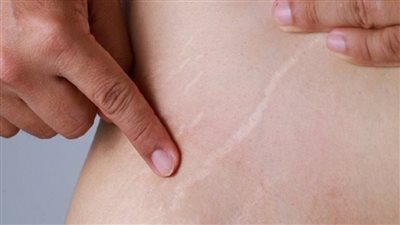 أفضل الزيوت الطبيعية للتخلص من علامات تمدد الجلد الحمراء