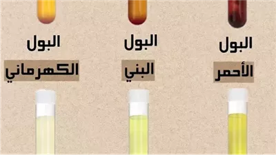 البول الأحمر جفاف حاد البول البني جفاف شديد