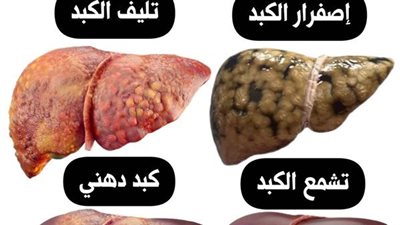 إصفرار الكبد بسبب الحصى أو الأورام تليف الكبد بسبب الكحول أو التعرض لبعض الأدوية تشمع الكبد كبد دهني ا كبد صحي خالي من أي أمراض سړطان الكبد