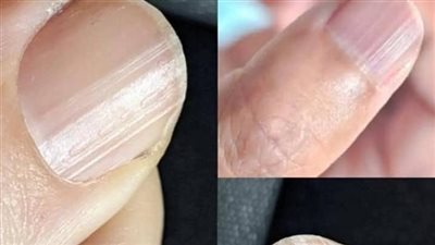 أظافرك تتحد ث ما الذي تعنيه الخطوط العمودية